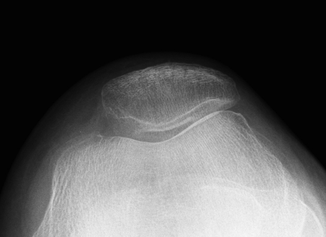 Patella Excessive Lateral Pressure 2